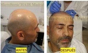 micropigmentación-capilar-tricopigmentacion-mujer-hombre-injerto